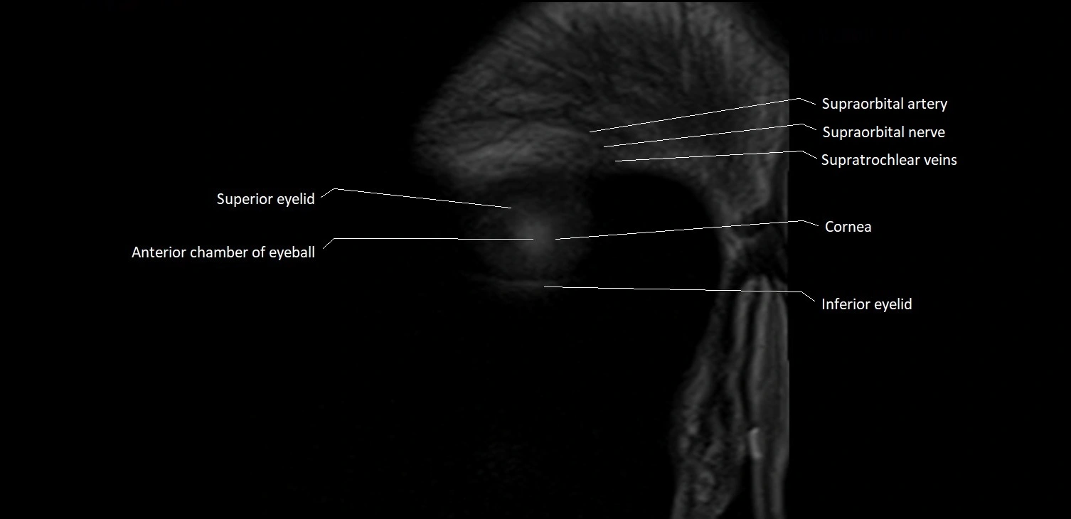 MRI Orbit coronal cross sectional anatomy image 1.webp